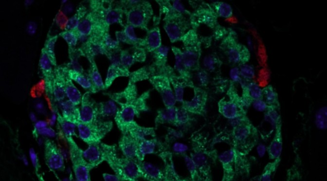 Possible mechanism for beta-cell loss in type 2 diabetes discovered